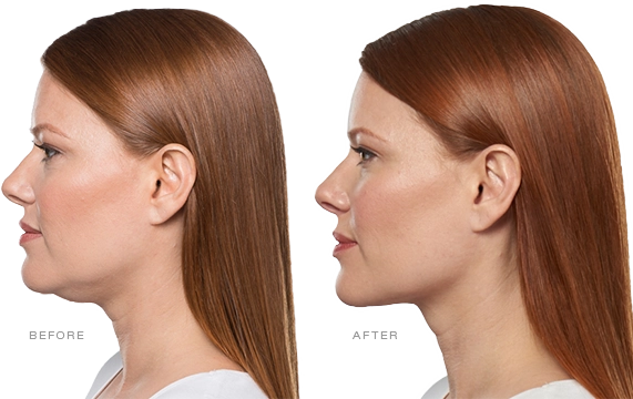 Kybella
