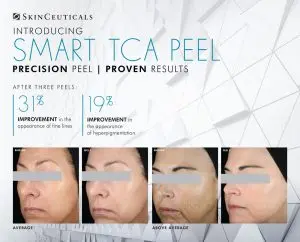 TCA Chemical Peel