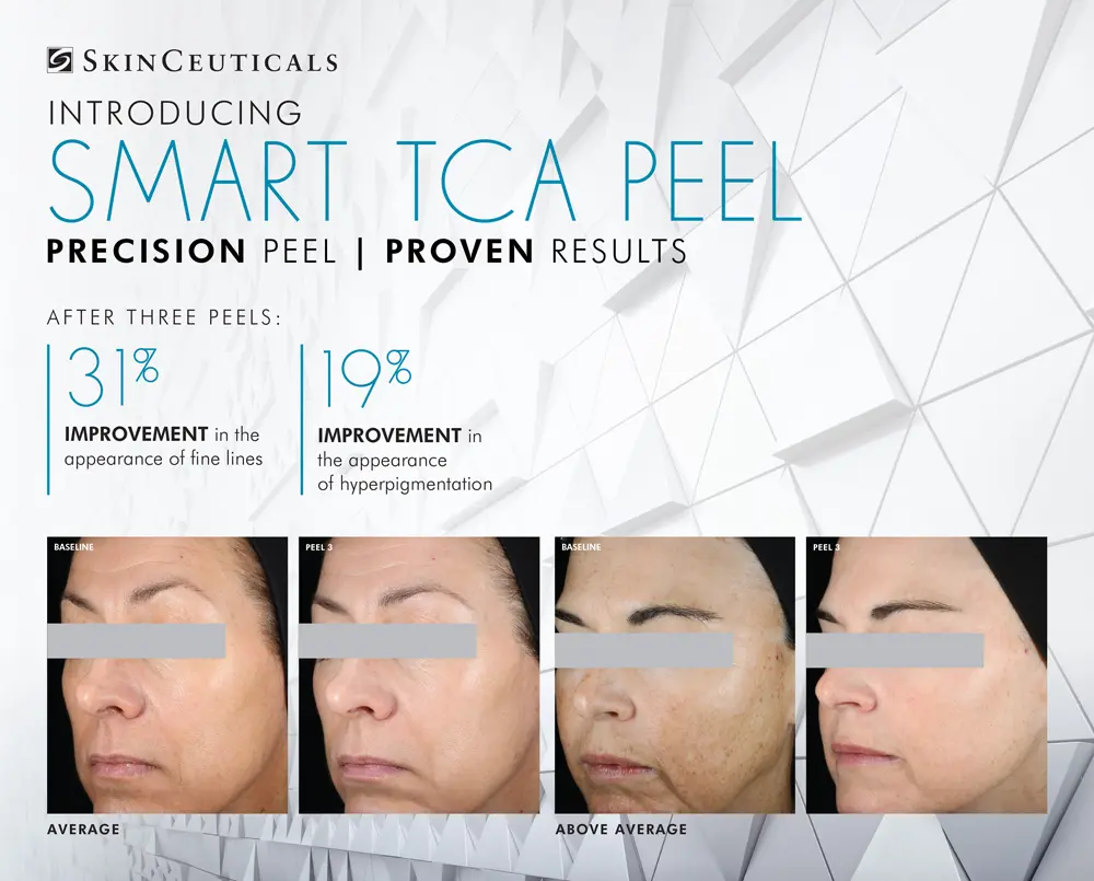TCA Chemical Peel