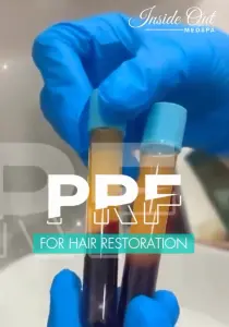 PRF hair restoration